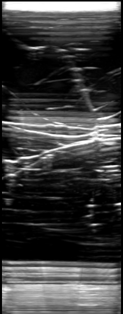 Ultrasound image showing reverberation artifacts